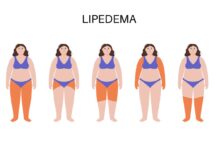 Dolor, hinchazón y dificultad para caminar: así impacta el lipedema en la vida de las mujeres