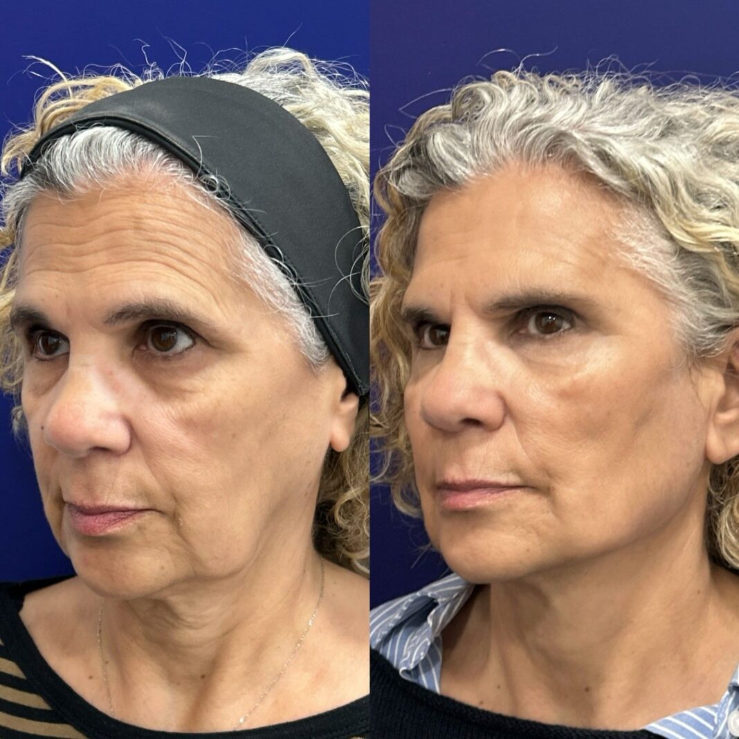 Antesydespus_GlobalFace