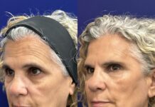 Global Face: nuevo protocolo integral del Dr. Ángel Martín para la recuperación de estructuras faciales, de la firmeza y elasticidad dérmica