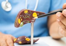 Dr. Juan Arenas, especialista en Aparato Digestivo de Policlínica Gipuzkoa: «La pérdida de peso es la clave para mejorar el hígado graso y el síndrome metabólico»