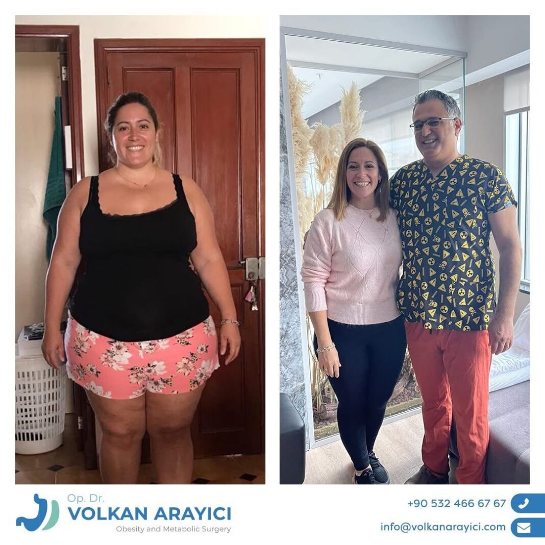 manga-gastrica-turquia-antes-despues