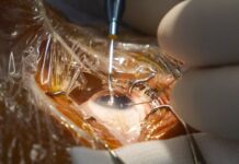 El codirector de FacoElche se somete en directo a la implantación bilateral de una lente diseñada con IA